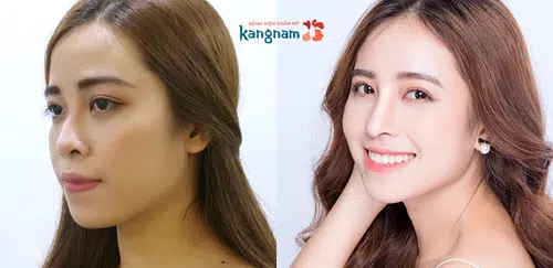 địa chỉ nâng mũi uy tín tại tphcm
