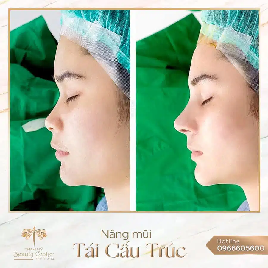 Thẩm mỹ Beauty Center by Tấm - Địa chỉ nâng mũi uy tín tại tphcm