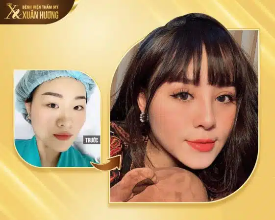 Bệnh viện thẩm mỹ Xuân Hương - Địa chỉ nâng mũi uy tín tại tphcm
