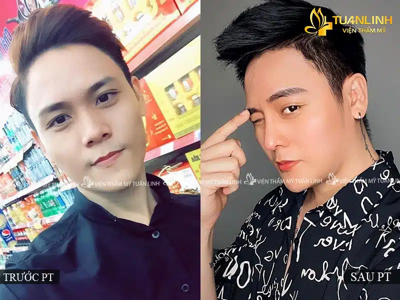 Viện thẩm mỹ Tuấn Linh - Địa chỉ nâng mũi uy tín tại tphcm