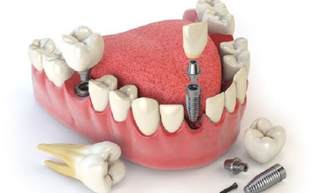 Top 14 địa chỉ trồng răng implant tại TPHCM uy tín nhất