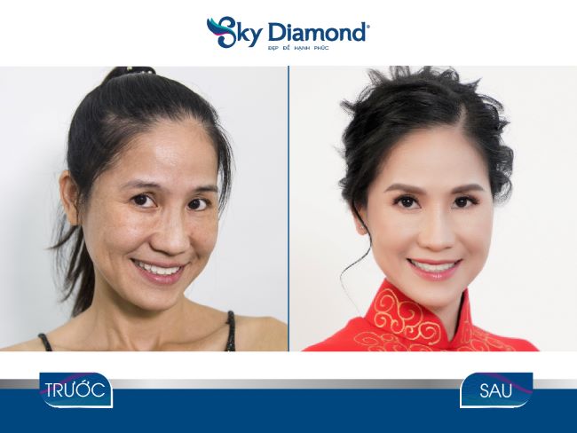 Với SkyDiamond, nhiều phụ nữ tuổi tứ tuần có khả năng giảm nếp nhăn, làm căng da chùng, nâng cơ chảy xệ | Nguồn: SkyDiamond