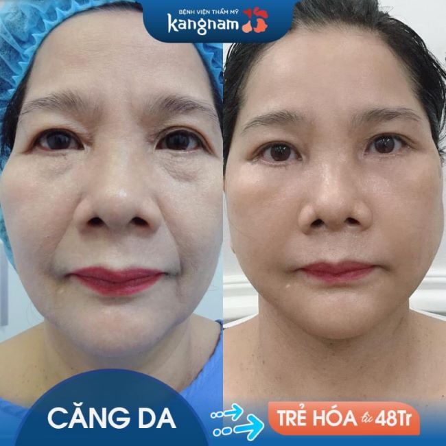Da mặt mịn màng, tươi trẻ là kết quả cuối cùng của liệu trình căng da mặt tại bệnh viện thẩm mỹ Kangnam | Nguồn: Bệnh viện thẩm mỹ Kangnam