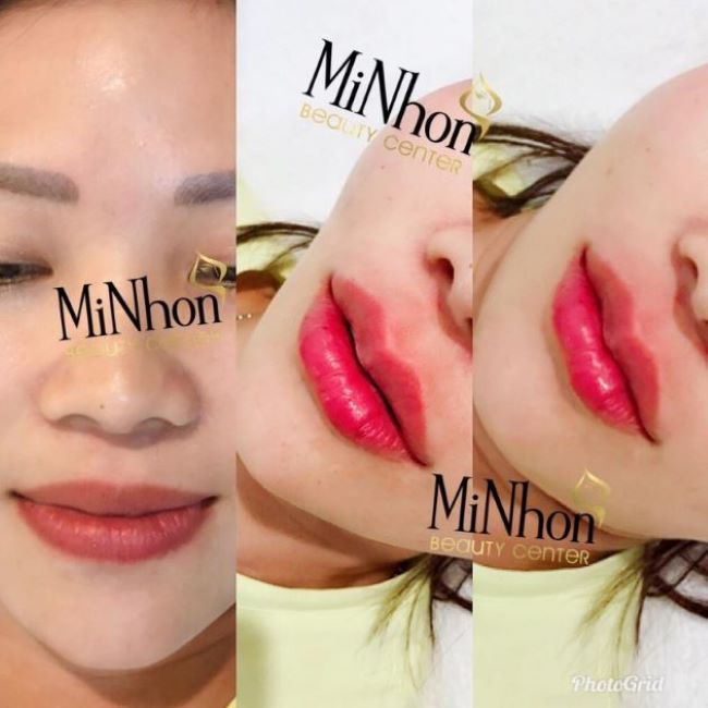 Tại Minhon Beauty Center, bạn sẽ được tư vấn liệu pháp tốt nhất cho tình trạng môi của mình | Nguồn: Minhon Beauty Center