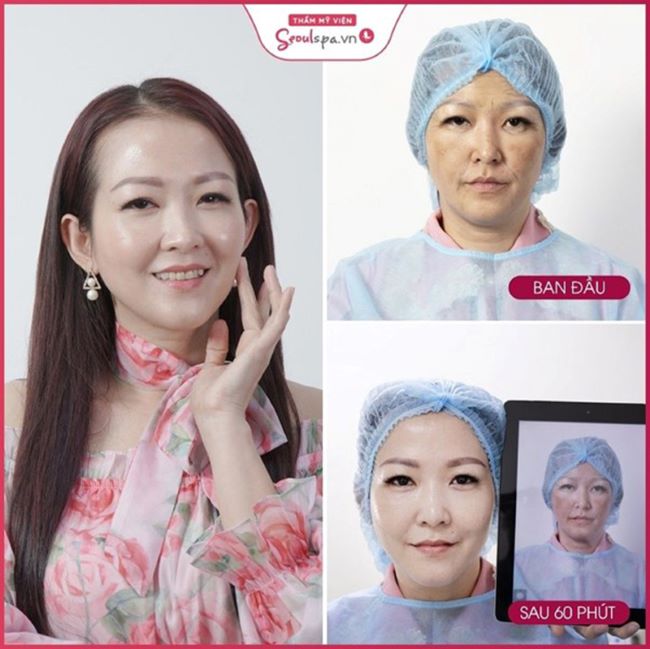 Quá trình căng da mặt bằng chỉ collagen tại Seoul Spa được thực hiện suôn sẻ và an toàn, không gây rủi ro cho da | Nguồn: Seoul Spa