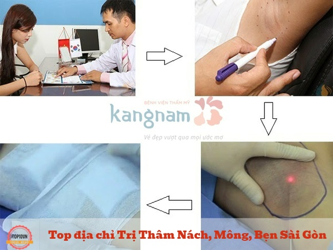 Thay vì dùng thuốc tẩy trắng, Kangnam sử dụng tia laser để trị thâm | Nguồn: Bệnh viện thẩm mỹ Kangnam