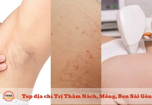 Top 12 địa chỉ Trị Thâm Nách, Mông, Bẹn uy tín Sài Gòn