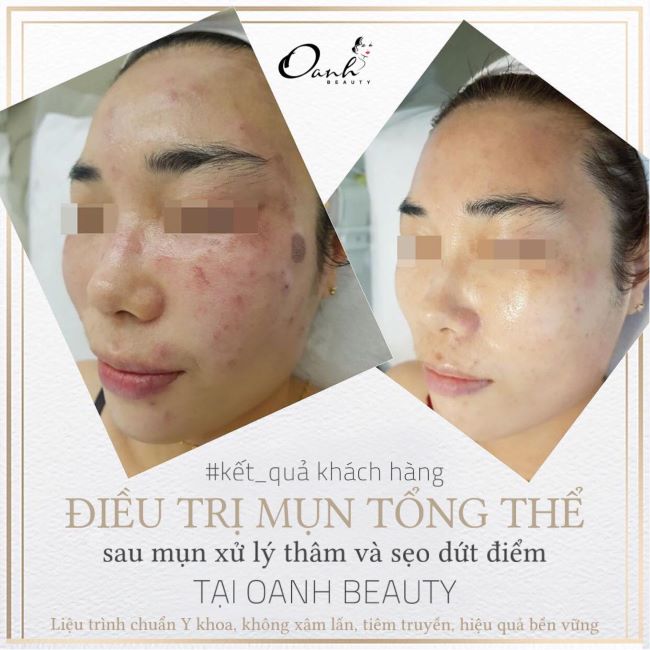 Hiện Oanh Beauty Spa là đại lý phân phối độc quyền các giải pháp điều trị da của MURAD - bác sĩ da đầu hàng đầu Hoa Kỳ | Nguồn: Oanh Beauty Spa
