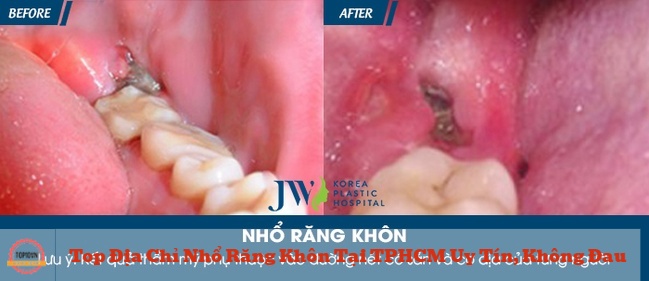 Kỹ thuật và trang thiết bị hiện đại đã giúp ca nhổ răng khôn tại Bệnh viện Thẩm mỹ JW thành công tốt đẹp | Nguồn: Bệnh viện Thẩm mỹ JW