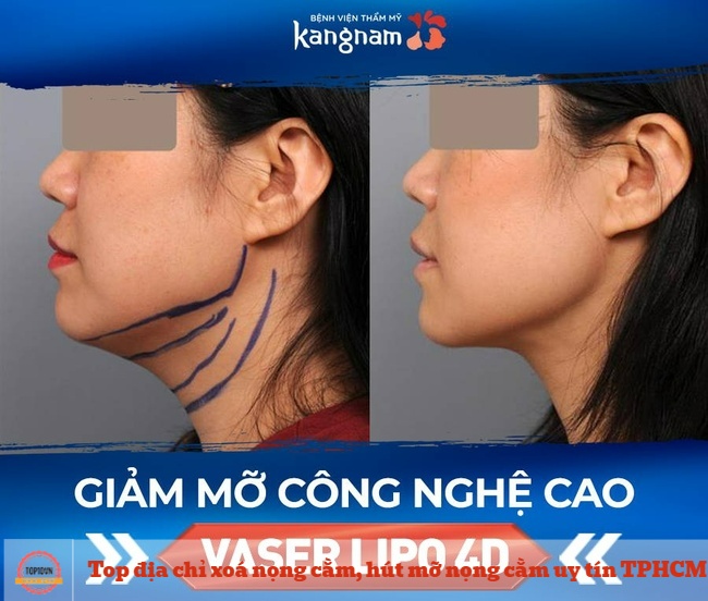 Sử dụng phương pháp hút mỡ Vaser Lipo 4D tại Kangnam, bạn hoàn toàn có thể sở hữu vẻ ngoài trẻ ra chục tuổi chỉ trong 30 phút nhờ những ưu điểm vượt trội | Nguồn: Bệnh viện Thẩm mỹ Kangnam 