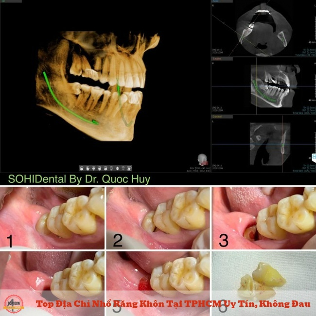 Dịch vụ nhổ răng khôn của Nha khoa SOHI hạn chế tối đa tình trạng đau nhức với công nghệ và máy móc chẩn đoán hiện đại | Nguồn: Nha khoa SOHI